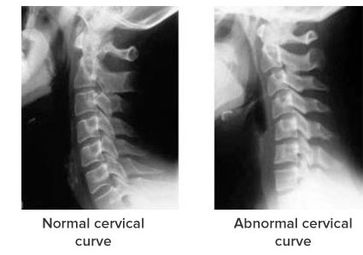 normal cervical curve versus abnormal cervical curve